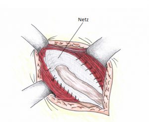 Leistenoperation Netz