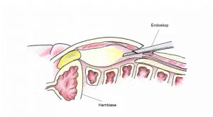 Leistenbruchoperation Endoskop